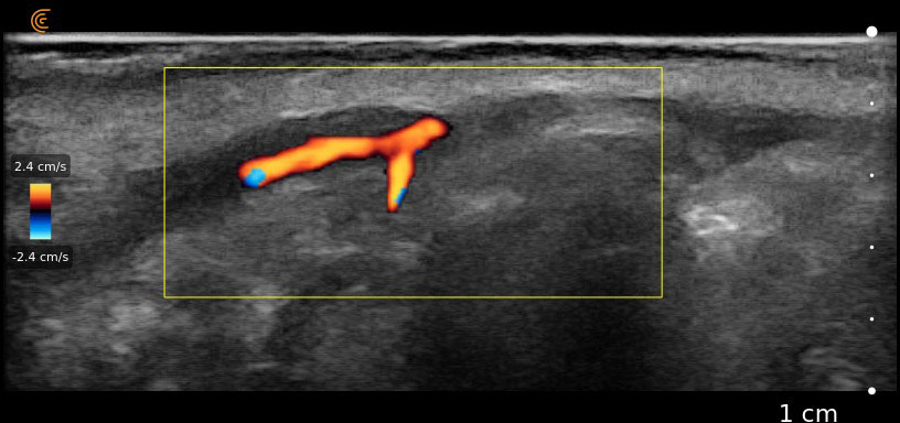 Clarius L20 - Arteria labial superior en procedimientos estéticos